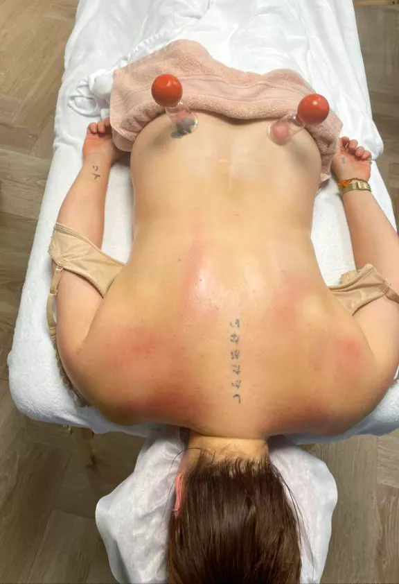 cuppingmassage 3
